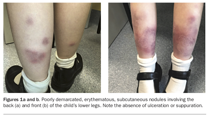 recurrent-painful-nodules-on-a-girl-s-legs-medicine-today